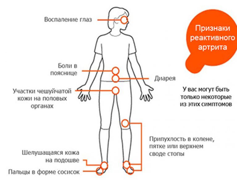 почему температура при артрозе плечевого сустава Вас